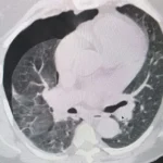 Успешное лапароскопическое вмешательство на кафедре хирургии ПДМУ спасло пациента