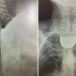 Эксклюзивные хирургические операции на кафедре хирургии ПДМУ за неделю