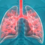 Свистяче дихання: як пов’язане з онкологією легень?