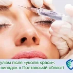 Ботулизм после инъекции ботулотоксина на Полтавщине